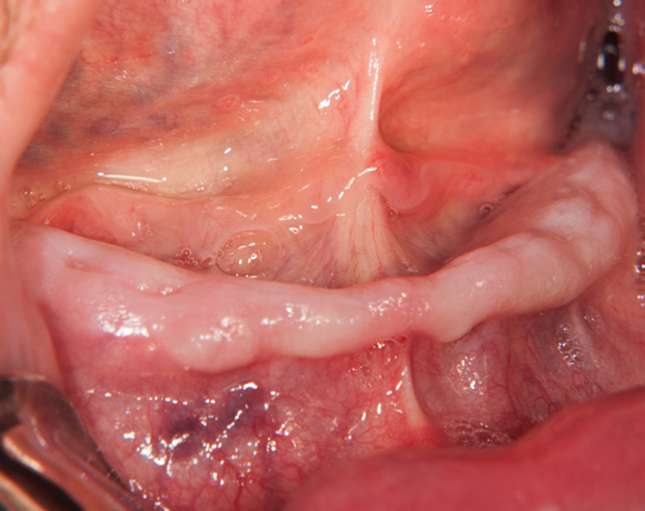 Zeramex loc Locator, Zeramex P Implantat