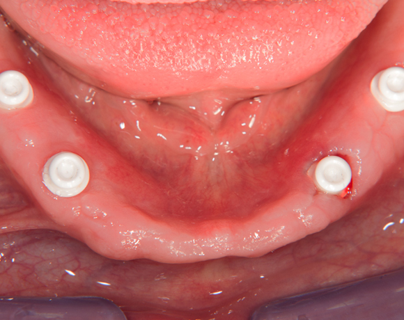 Zeramex loc Locator, Zeramex P Implantat, Novaloc, Valoc, PEEK Geru00fcst