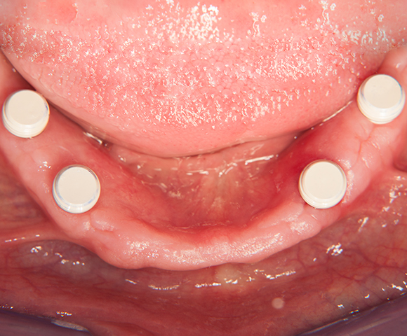 Zeramex loc Locator, Zeramex P Implantat, Novaloc, Valoc, PEEK Geru00fcst