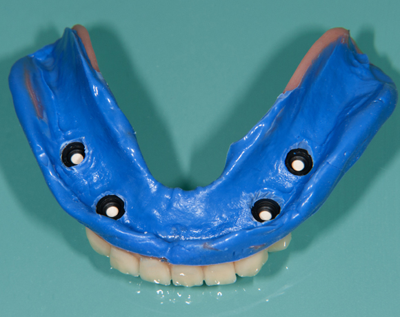 Zeramex loc Locator, Zeramex P Implantat, Novaloc, Valoc, PEEK Geru00fcst