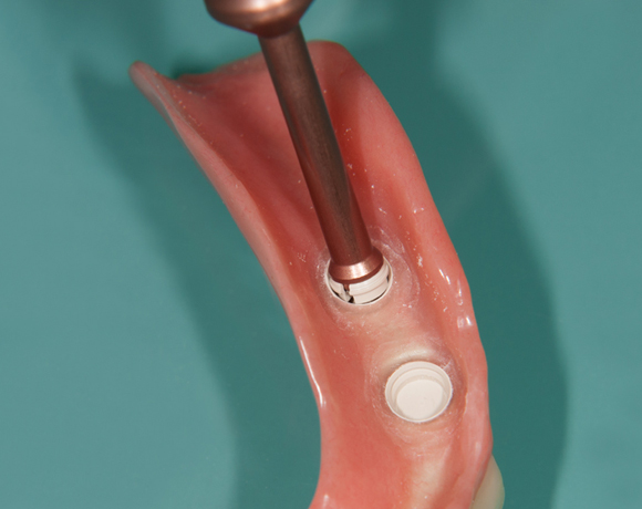 Zeramex loc Locator, Zeramex P Implantat, Novaloc, Valoc, PEEK Geru00fcst
