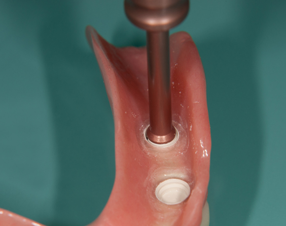 Zeramex loc Locator, Zeramex P Implantat, Novaloc, Valoc, PEEK Geru00fcst