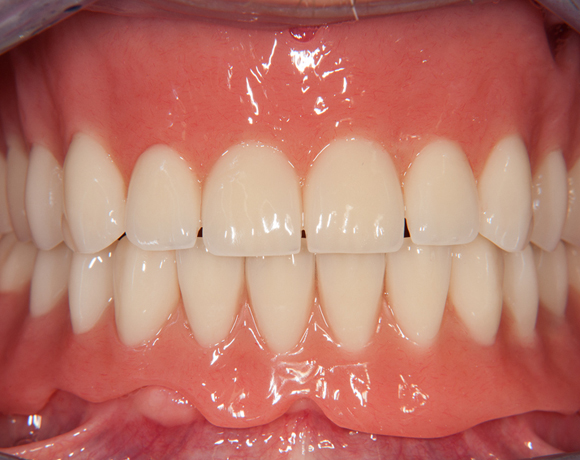 Zeramex loc Locator, Zeramex P Implantat, Novaloc, Valoc, PEEK Geru00fcst