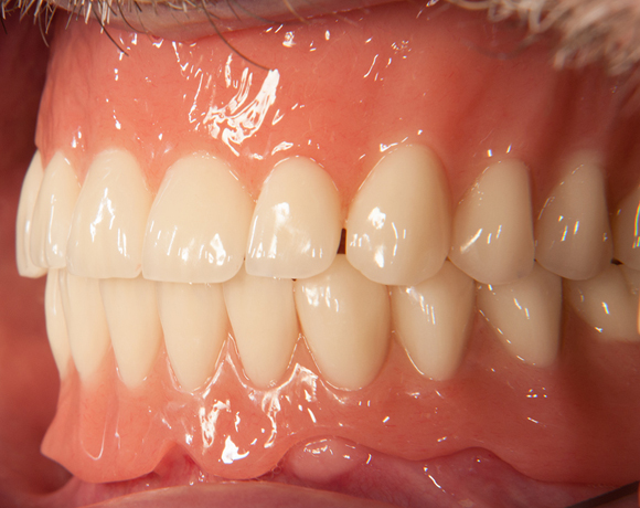 Zeramex loc Locator, Zeramex P Implantat, Novaloc, Valoc, PEEK Geru00fcst
