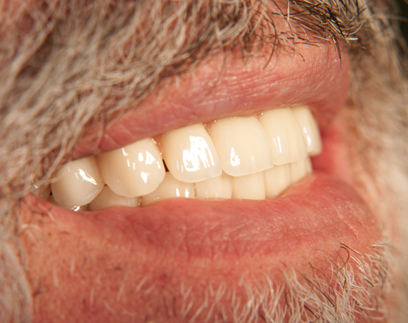 Zeramex loc Locator, Zeramex P Implantat, Novaloc, Valoc, PEEK Geru00fcst